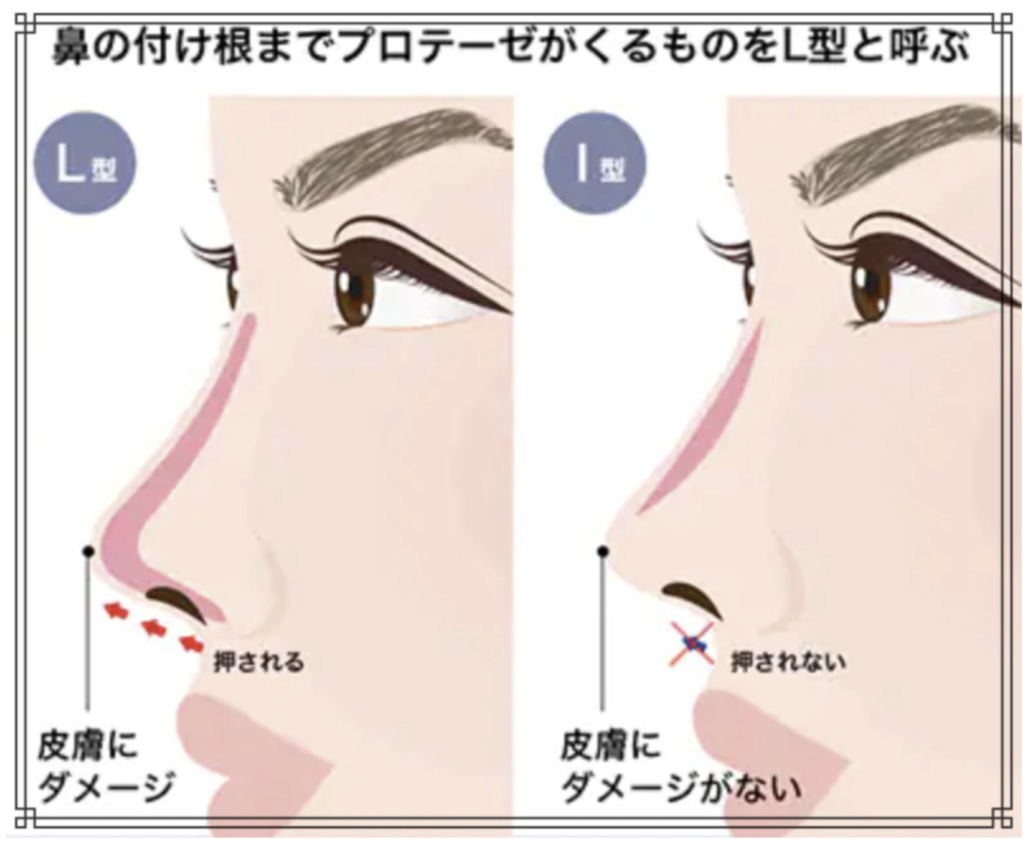 鼻プロテーゼの説明画像