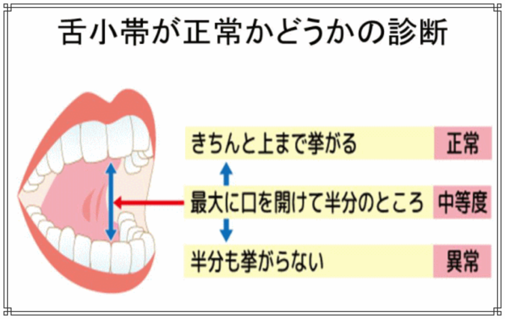 舌小帯（ぜんしょうたい）短縮症のイメージ図